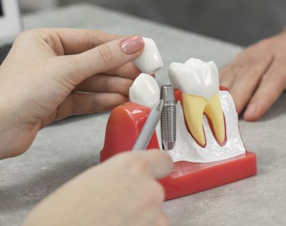 What Are the Benefits of Choosing Dental Implants?